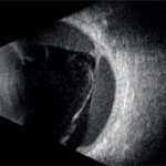 Askin - Quantel Medical - ABSolu