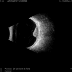 Askin - Quantel Medical - ABSolu