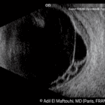 Askin - Quantel Medical - Compact Touch