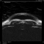 Askin - Quantel Medical - ABSolu