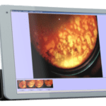 Askin - Keeler - Indirektny oftalmoskop Vantage Plus LED Digital