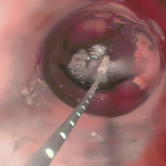 Askin - PENTAX Medical - Cryo Baloon C2