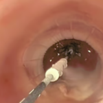 Askin - PENTAX Medical - Cryo Baloon C2